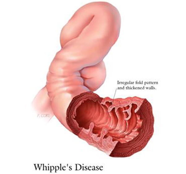 Whipple_s disease